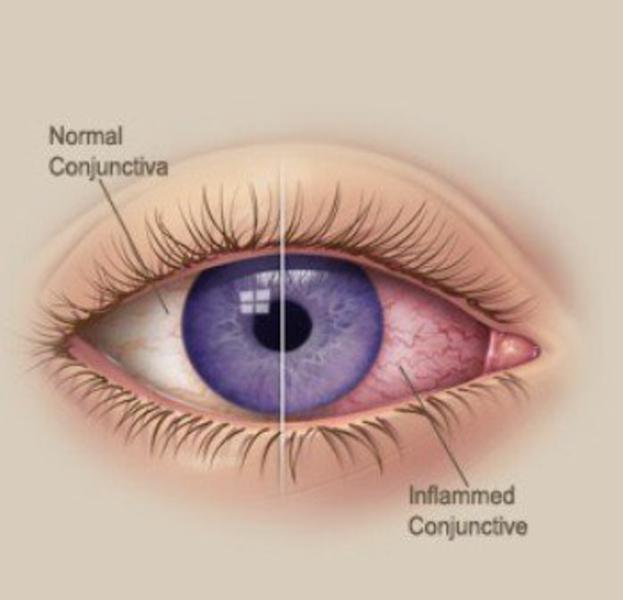 Conjuntivite: causas, sintomas, transmissão e tratamento